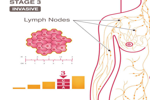 >Breast Cancer Hospital In Thane -What Types Of Cancer Are Diagnosed As Stage 3 (III) A, B, And C Breast Cancer?