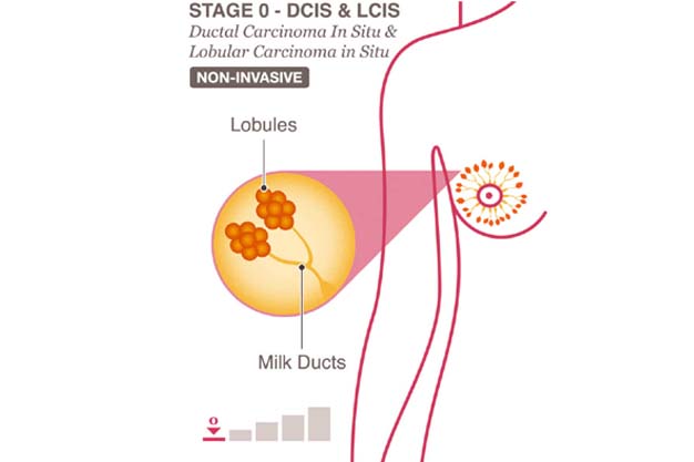 Breast Cancer Hospital in Thane - Breast Cancer Stage 0 And Stage 1